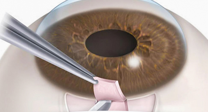 Cirurgia de glaucoma: conheÃ§a as tÃ©cnicas disponÃ­veis e critÃ©rios para eleger cada uma